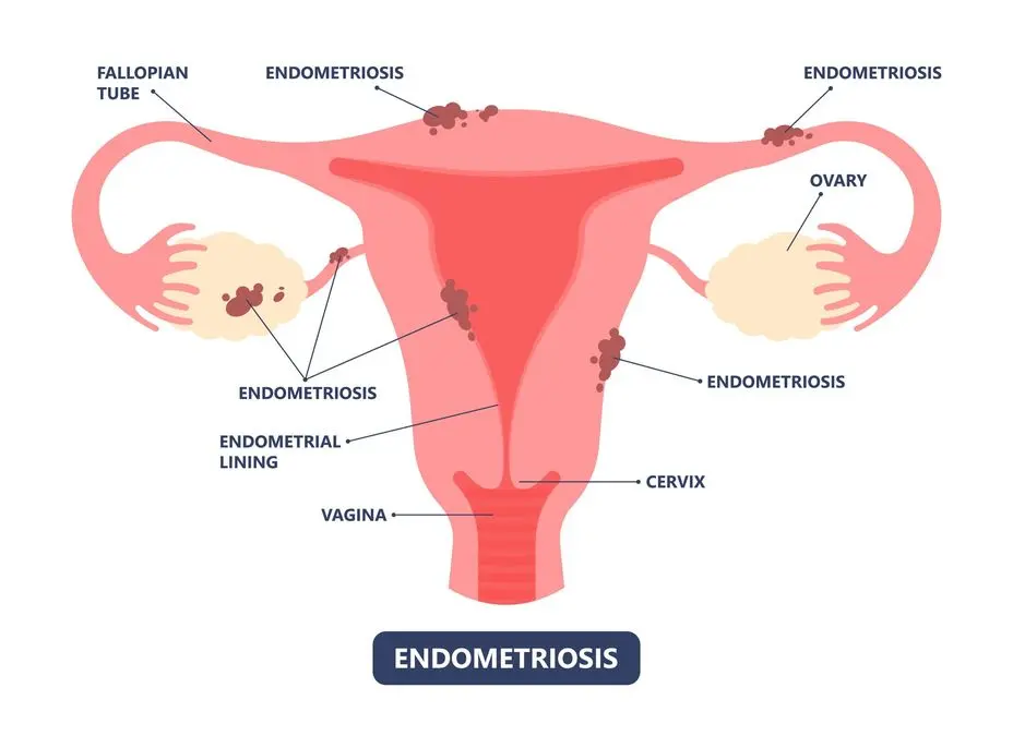 Endometriosis