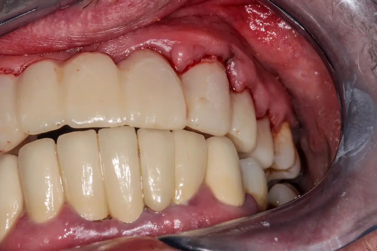 Patient showing very bad case of periodontitis under a spanning bridge