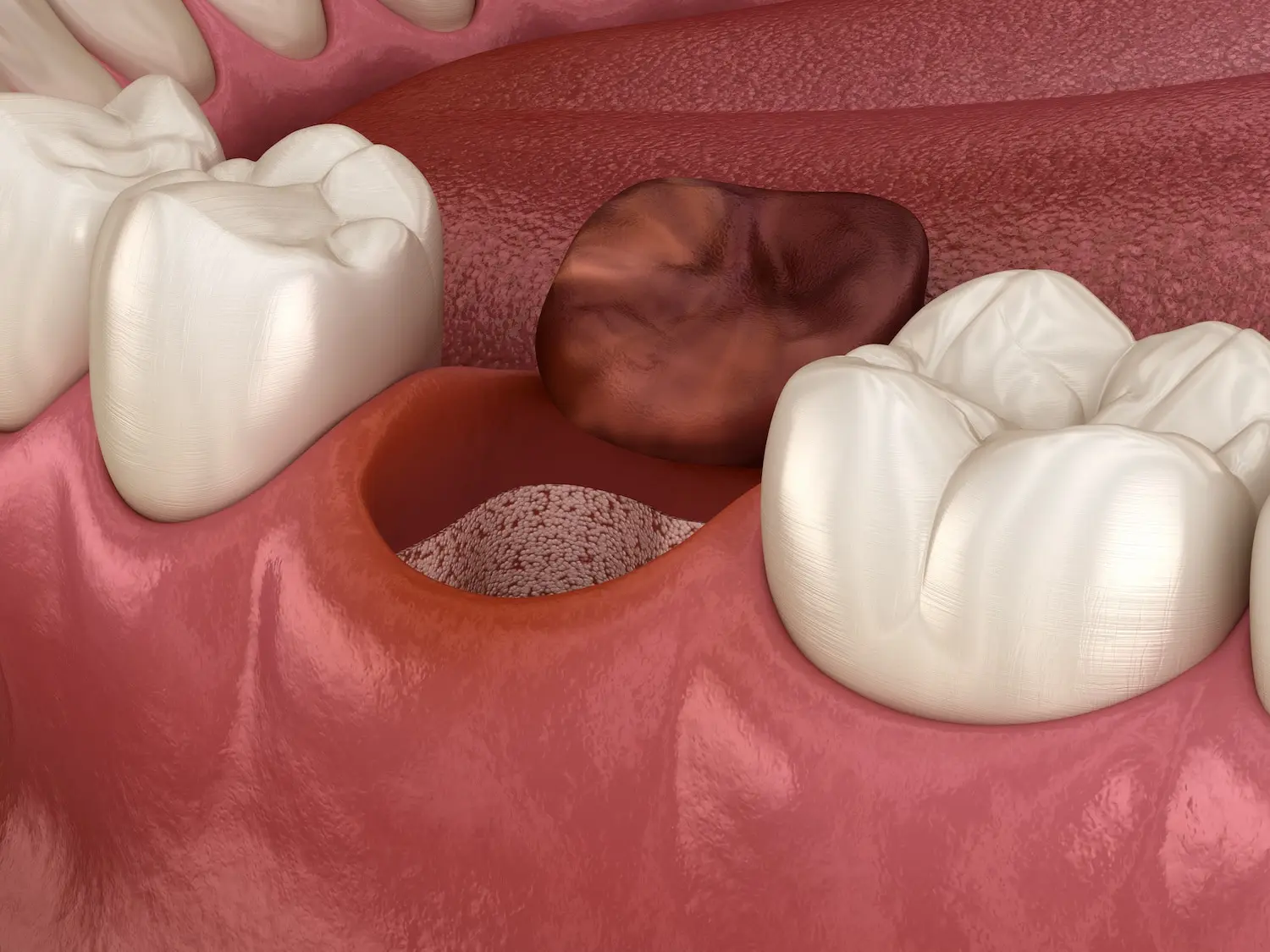 dry socket symptoms up close graphic of empty tooth socket after extraction