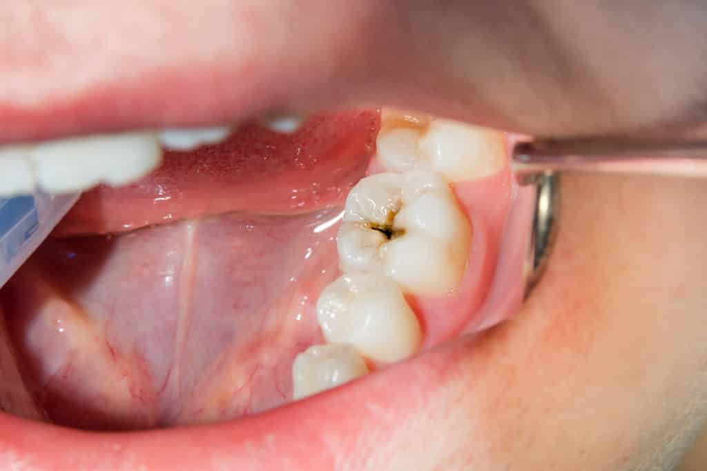 how to cover front tooth close up of molar cavity in mouth cavity