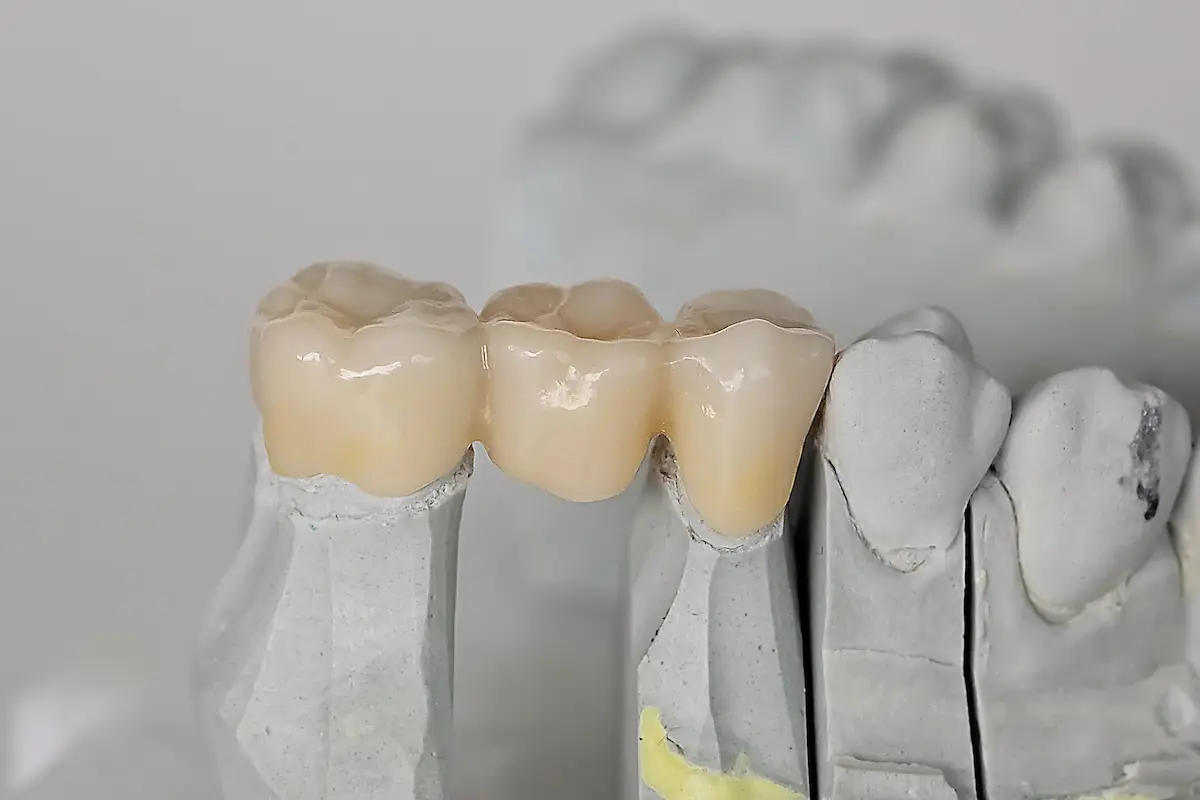 A close-up of a dental bridge model showing three artificial teeth connected