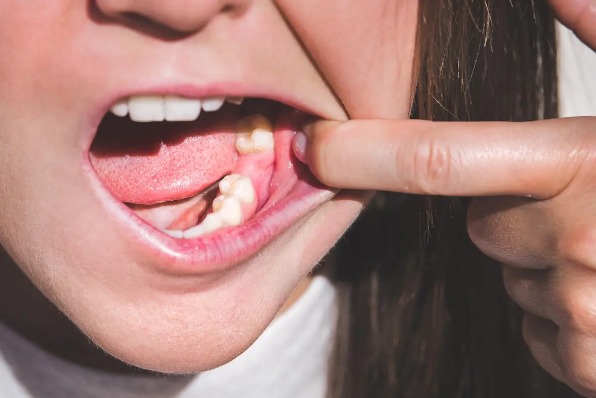 Close-up of a person pulling back their cheek to show a missing tooth and adult molars growing in their lower gum.