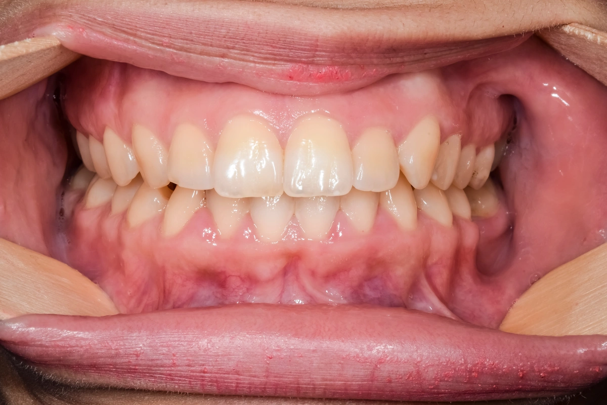 close up to front teeth arches