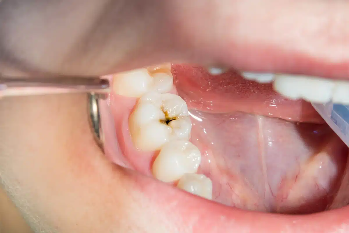 cavity on tooth close up image