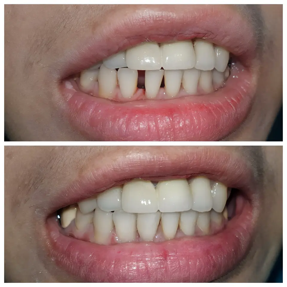 before and after bonding
