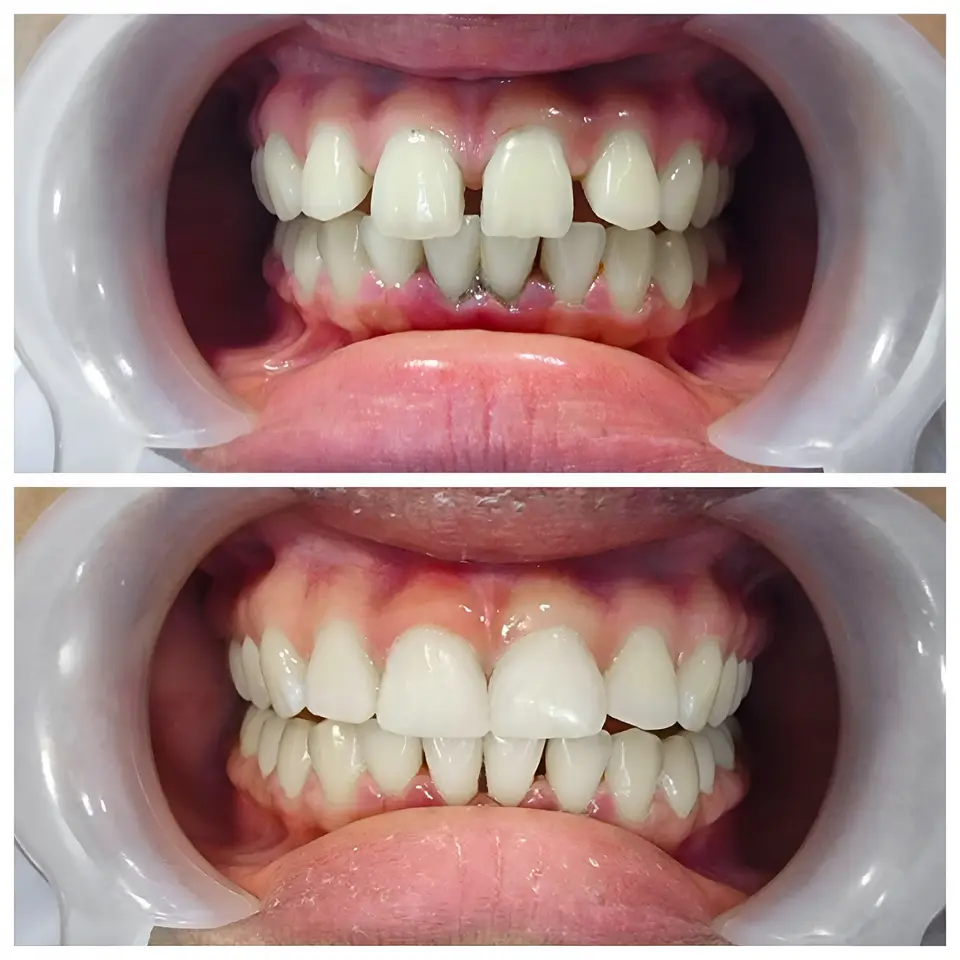 before and after tooth bonding