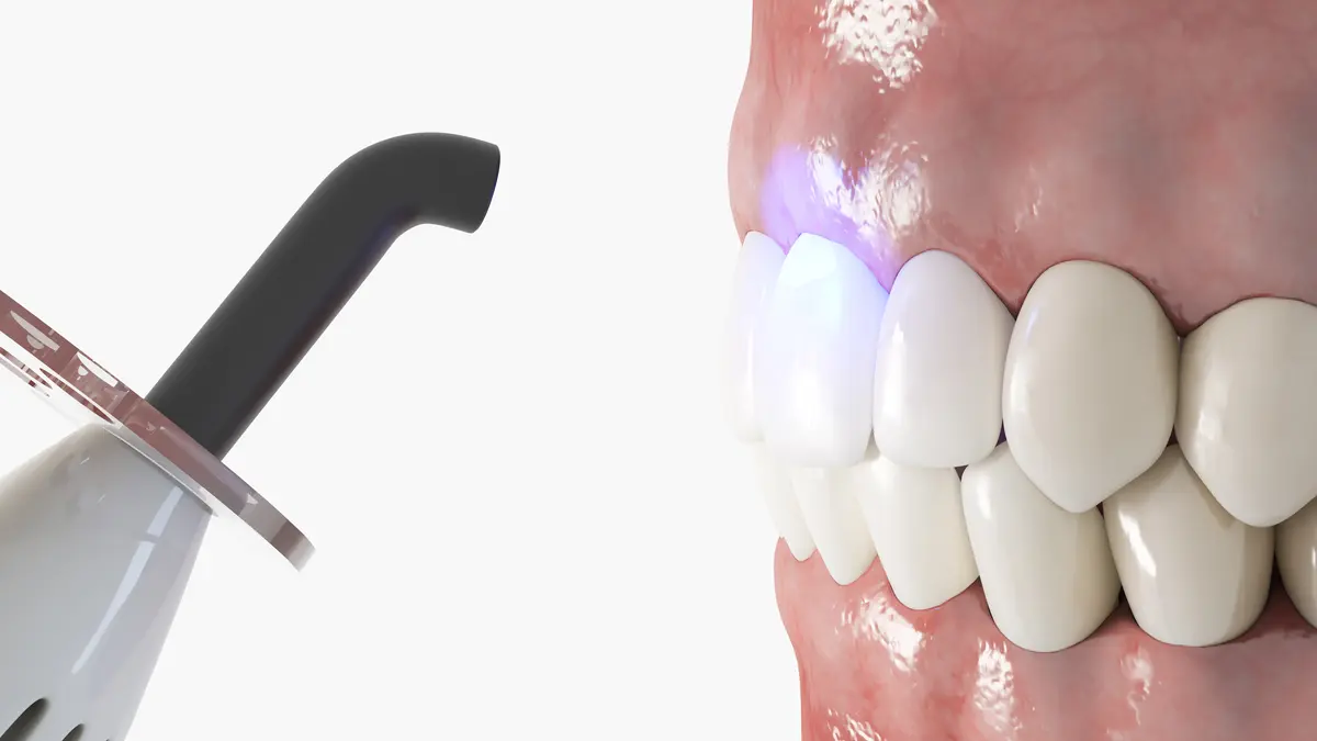 dental bonding
