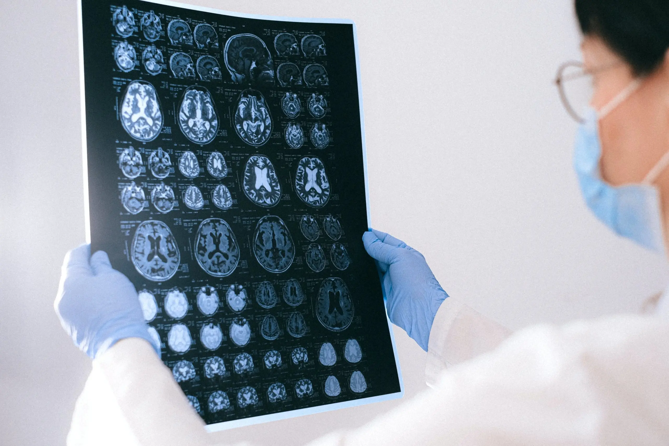 ¿Cómo se utiliza una resonancia magnética para diagnosticar la enfermedad de Alzheimer?