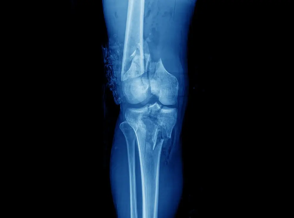 Imagen detallada en blanco y negro de una resonancia magnética que muestra los huesos, cartílagos y ligamentos de una rodilla humana.