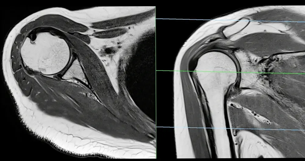 resonancia magnética musculoesquelética