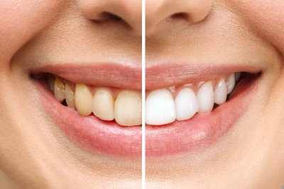 Teeth Whitening in Manhattan