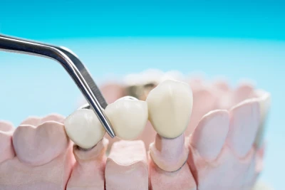 Dental bridge