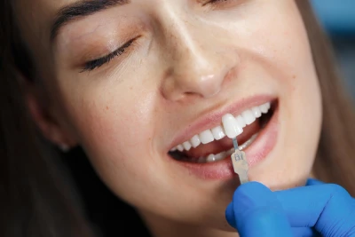 Dental veneer placement illustration showing porcelain veneer bonded to the front surface of a tooth