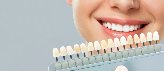 Cosmetic dentistry results showing improved tooth shape and symmetry with veneers