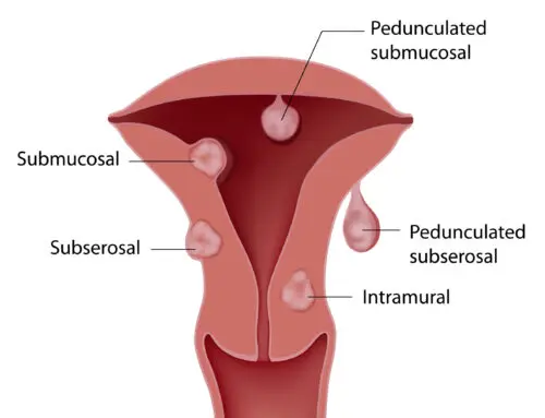 Uterine Fibroids and How Our Doctors Help You Manage Them