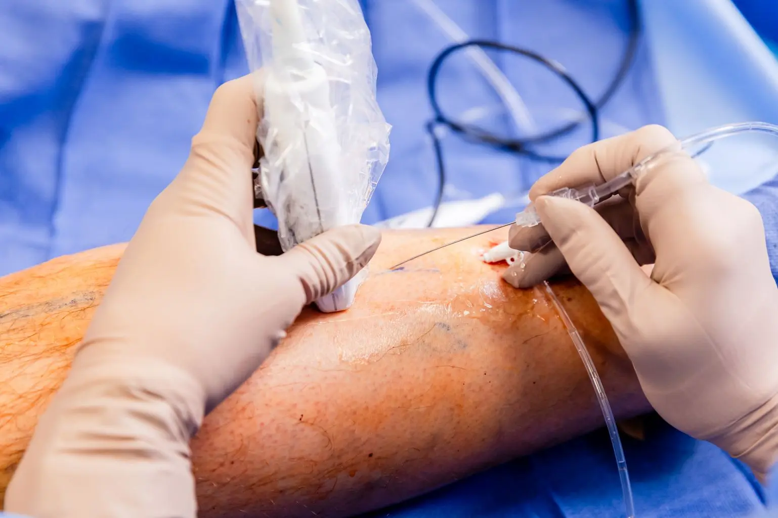 Provider places needle into patient's skin to as part of a treatment for varicolse vein removal near New Albany, OH