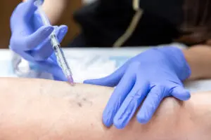 A close up of a provider wearing gloves performing sclerotherapy near New Albany, OH