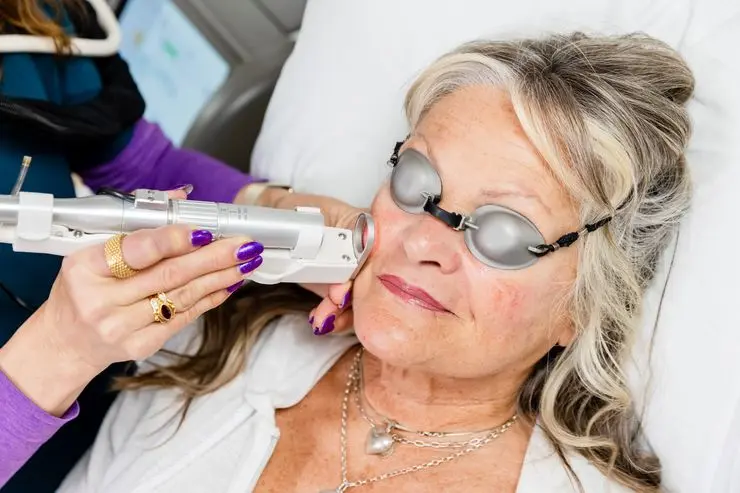 Laser treatment for facial veins