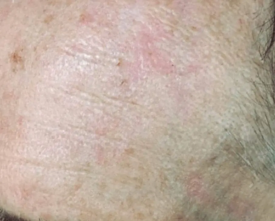 Skin Conditions and Antiaging