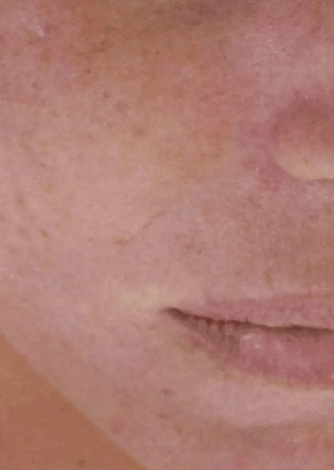 Skin Conditions and Antiaging