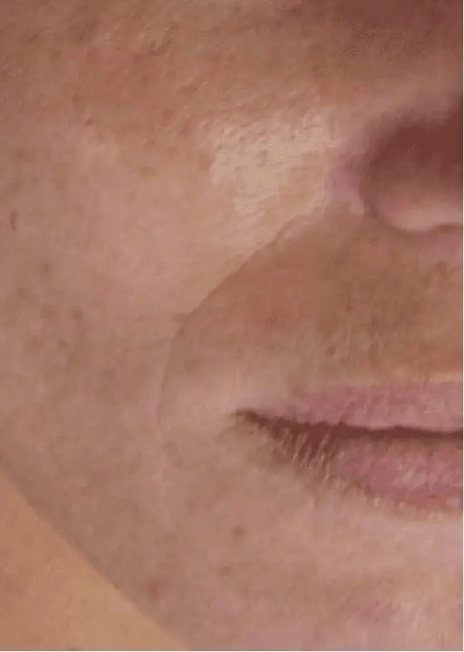 Skin Conditions and Antiaging