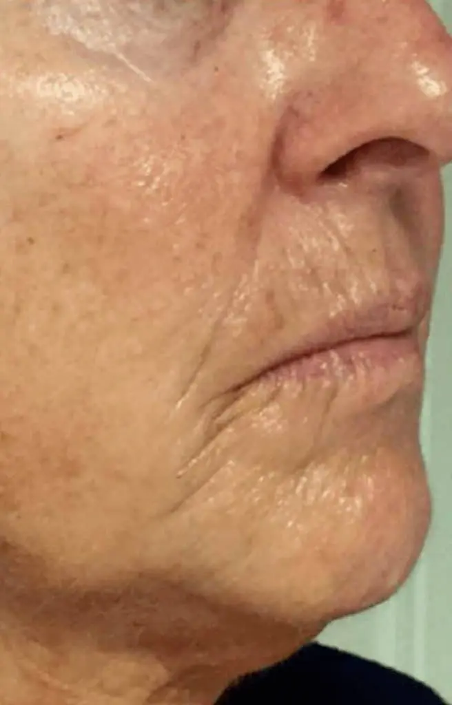 Skin Conditions and Antiaging