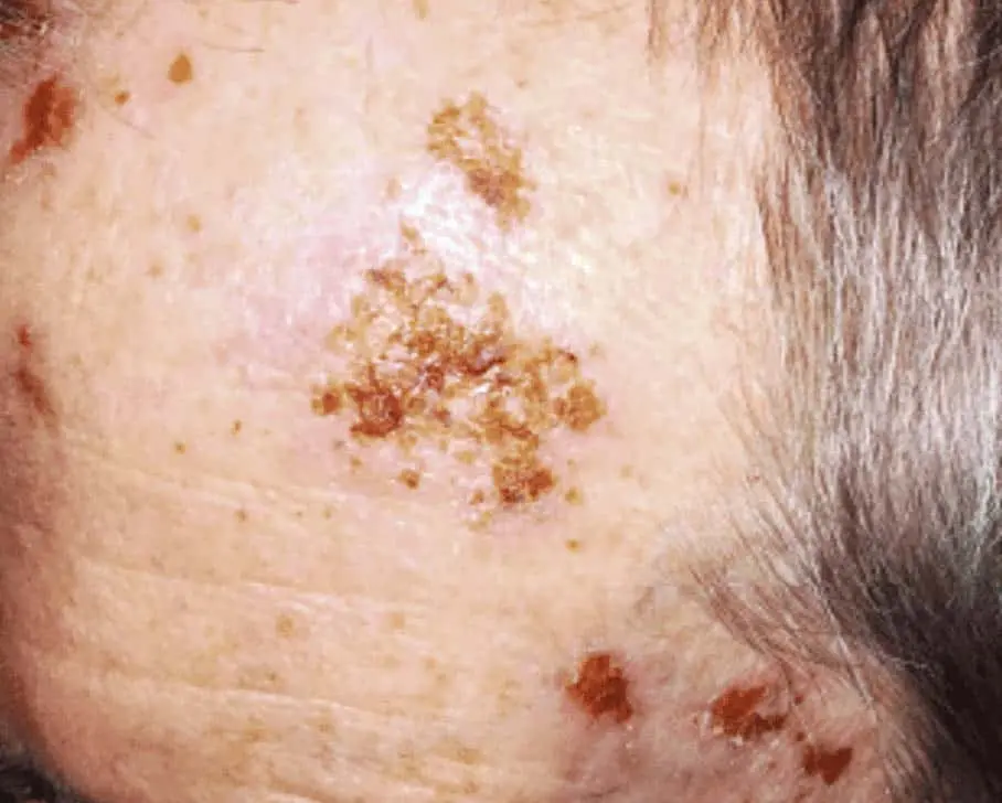 Skin Conditions and Antiaging