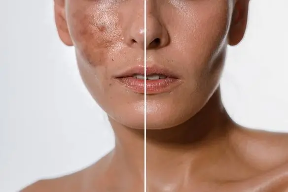 melasma on face before and after