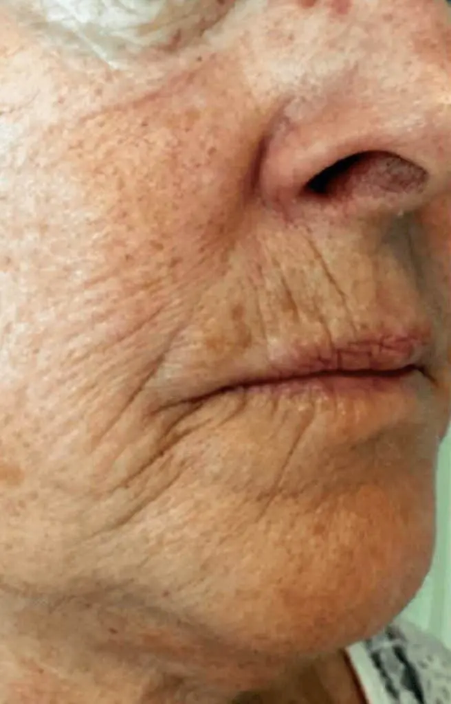 Skin Conditions and Antiaging