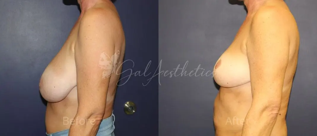 LR 1 year_ post-op pre-op 4