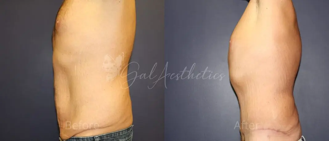 JB 3 month_ post-op pre-op 3