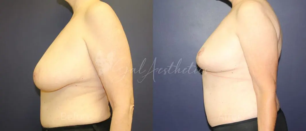 LB F month_ post-op pre-op 4