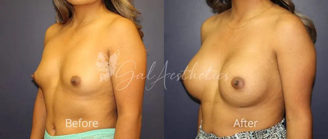 Breast Augmentation MMS 2