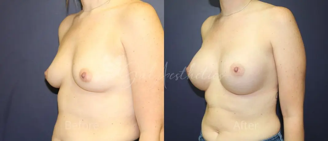 KW 3 month_ post-op pre-op 4