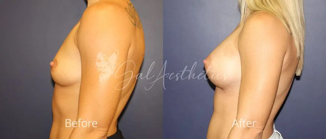 Breast Augmentation TB 2