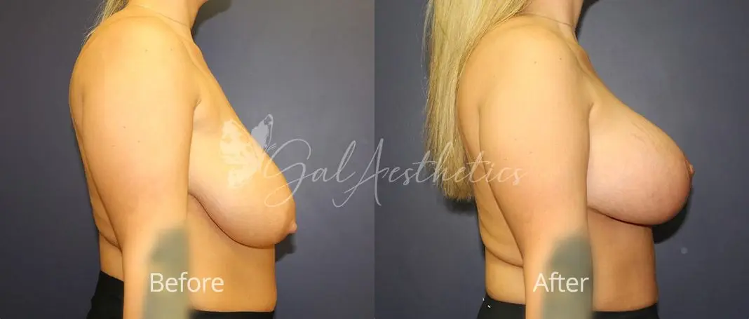 Breast Augmentation with lift EM 3