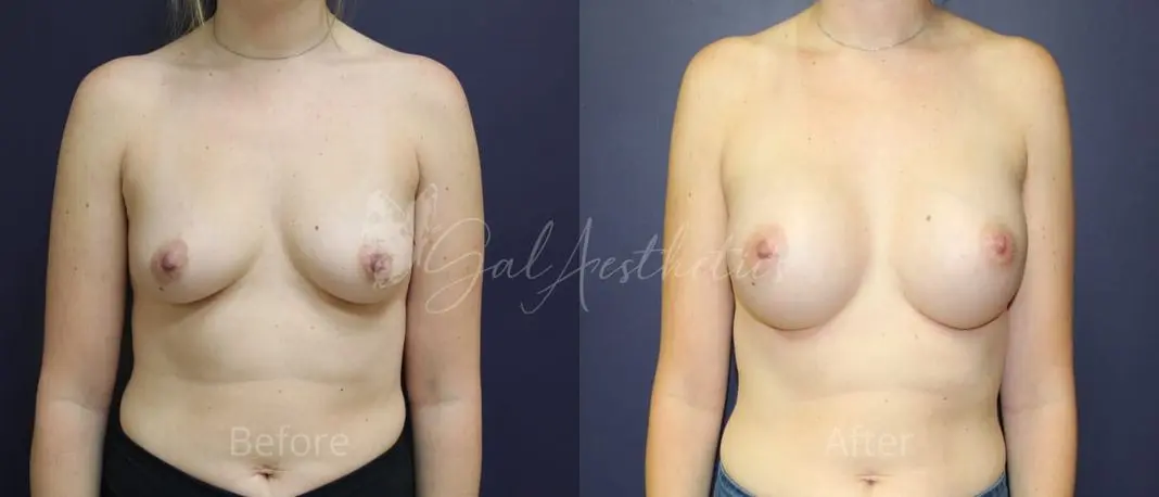 KW 3 month_ post-op pre-op 1