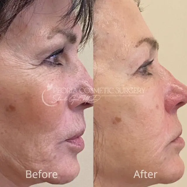 peoria-before-after-PRX case 1d