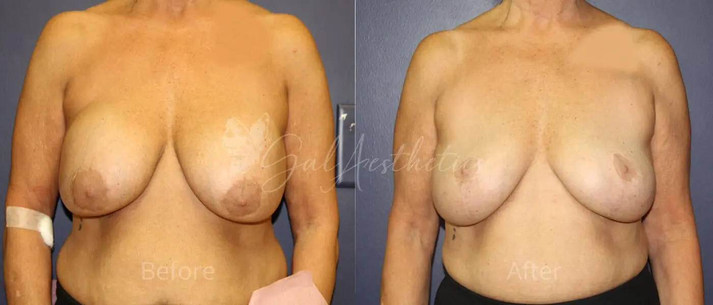 LGC 8 month_ post-op pre-op 1