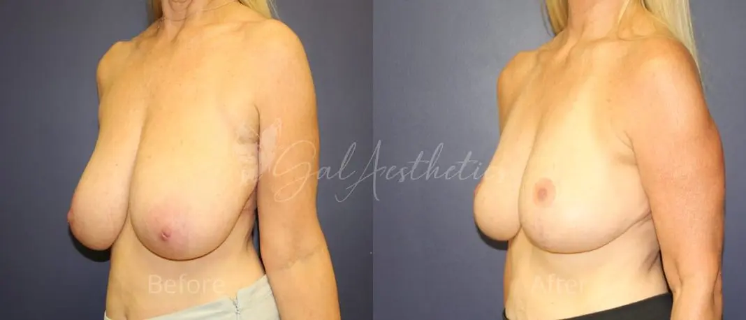 MA 1 year_ post-op pre-op 5