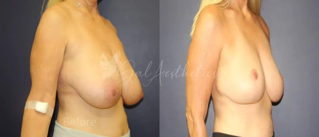MA 1 year_ post-op pre-op 2