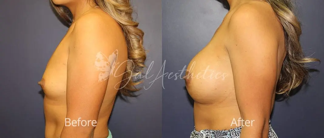 Breast Augmentation MMS 1