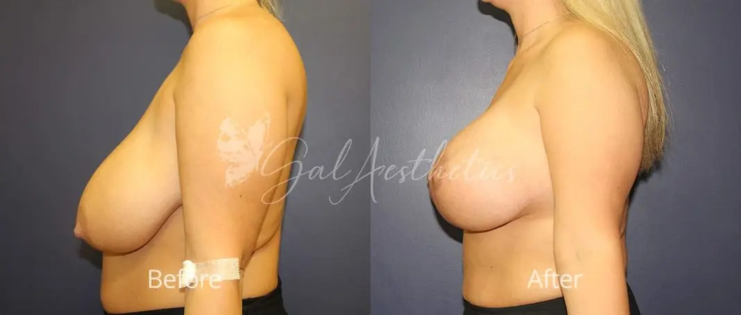 Breast Augmentation with lift EM 2