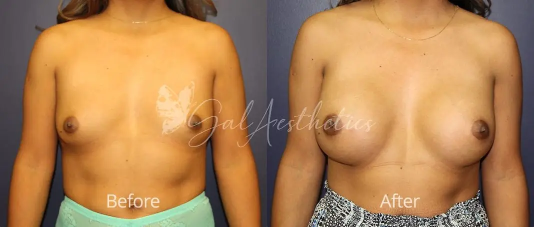 Breast Augmentation MMS 5