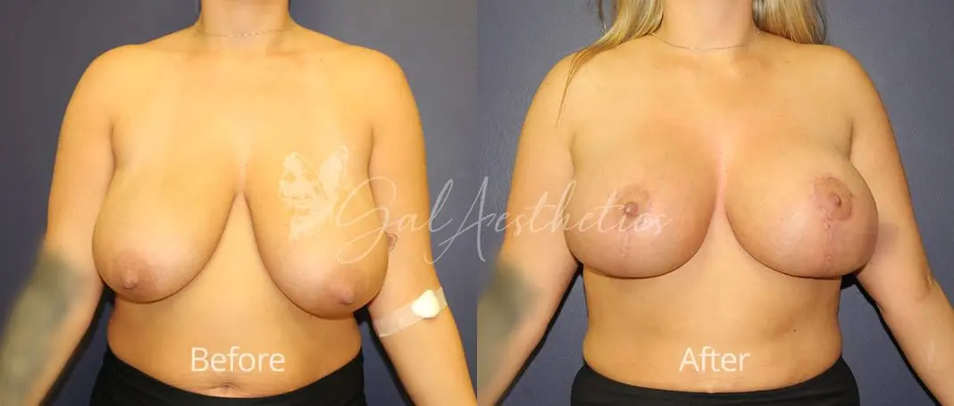 Breast Augmentation with lift EM 5
