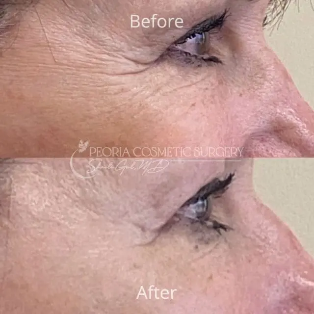 peoria-before-after-PRX Case 1b