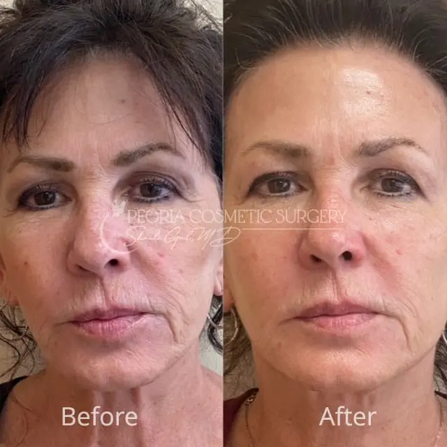 peoria-before-after-PRX Case 1a