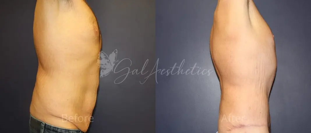 JB 3 month_ post-op pre-op 2