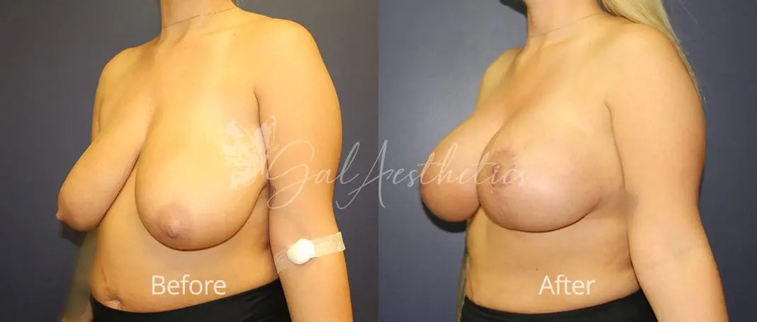 Breast Augmentation with lift EM 1