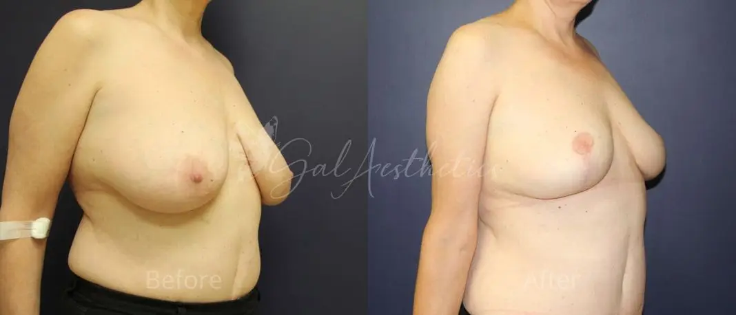 LB F month_ post-op pre-op 2